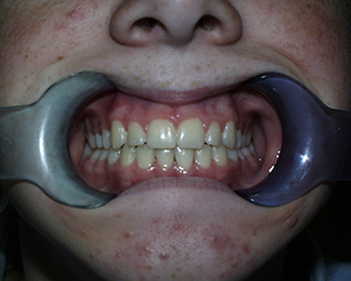 After image showing aligned teeth
