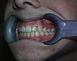 After image showing aligned teeth