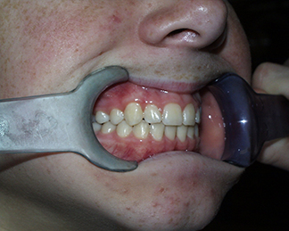 After image showing aligned teeth