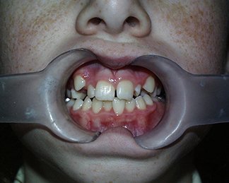 Before image showing misaligned teeth