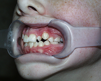 Before image showing misaligned teeth