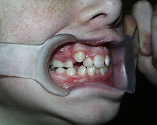 Before image showing misaligned teeth