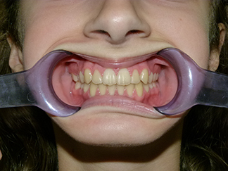 After image showing aligned teeth