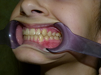 After image showing aligned teeth