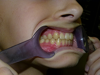 After image showing aligned teeth