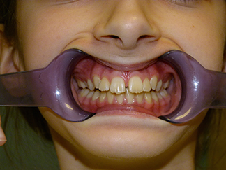 Before image showing misaligned teeth