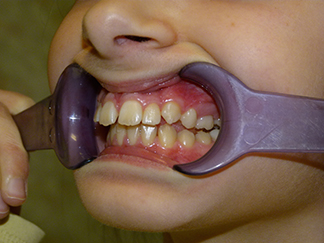 Before image showing misaligned teeth