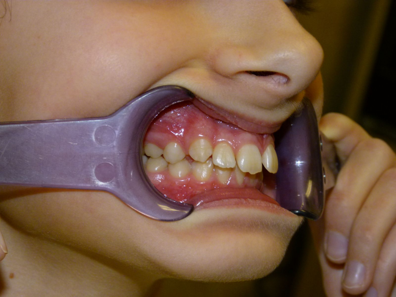 Before image showing misaligned teeth