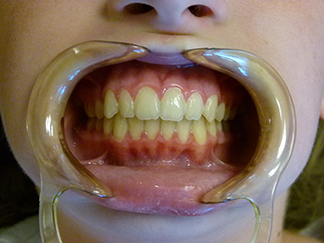 After image showing aligned teeth