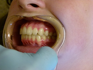 After image showing aligned teeth