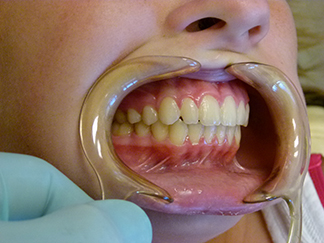 After image showing aligned teeth