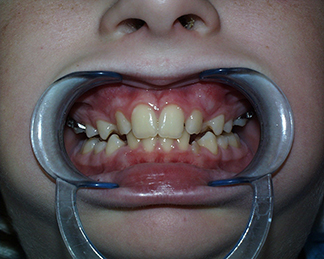 Before image showing misaligned teeth