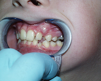 Before image showing misaligned teeth