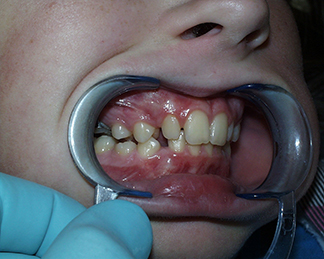 Before image showing misaligned teeth