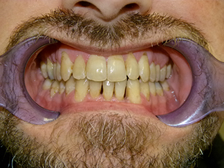After image showing aligned teeth