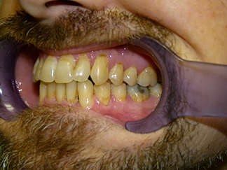 After image showing aligned teeth