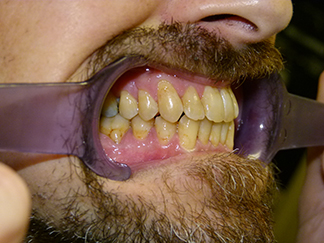 After image showing aligned teeth