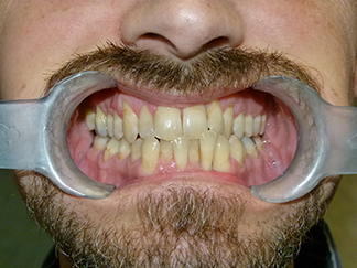 Before image showing misaligned teeth