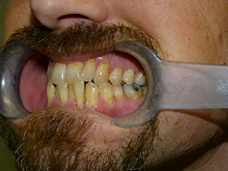 Before image showing misaligned teeth