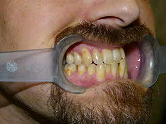 Before image showing misaligned teeth