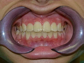 After image showing aligned teeth