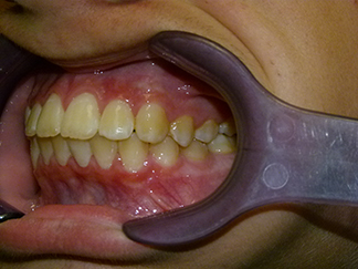 After image showing aligned teeth
