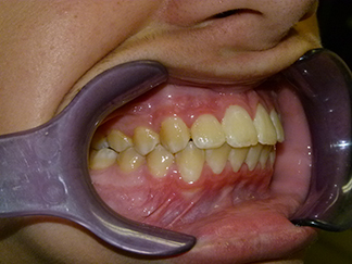 After image showing aligned teeth