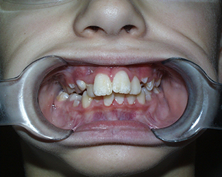 Before image showing misaligned teeth