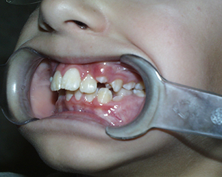 Before image showing misaligned teeth