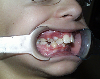 Before image showing misaligned teeth