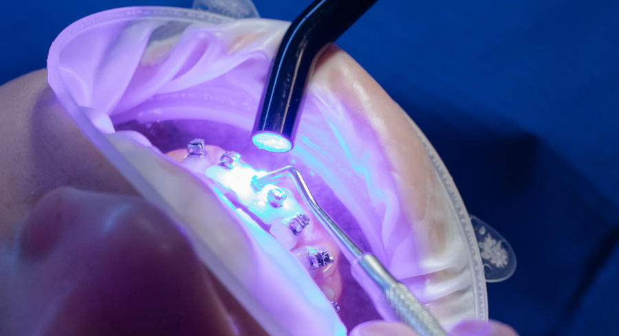 An orthodontist applying brackets to the teeth and bonding them with a bonding gun