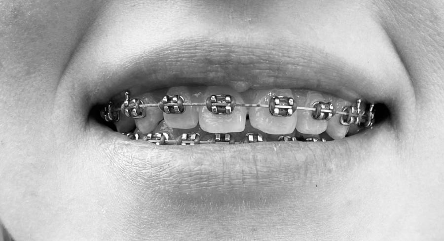 A close up image of a smiling woman with braces