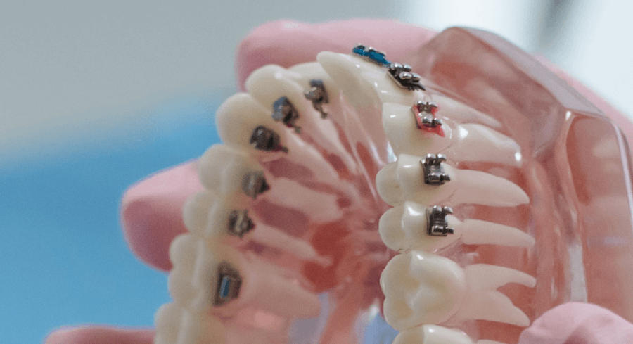 A plastic mouth model with different kinds of braces on the teeth