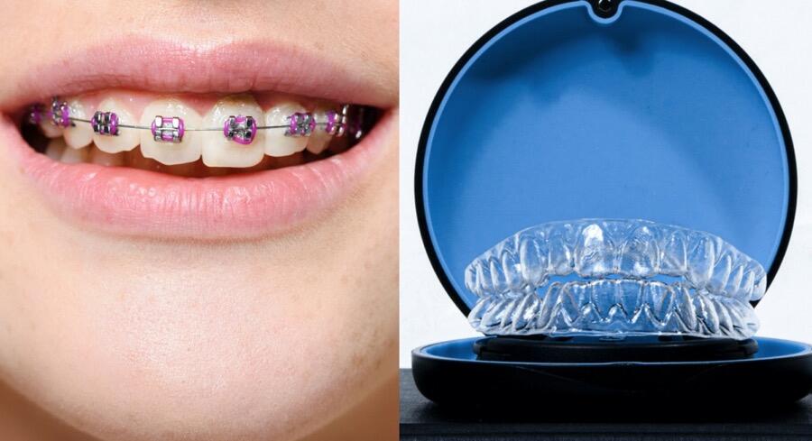 A woman with pink braces on the left side of the image compared to aligners on a table top on the right side of the image.