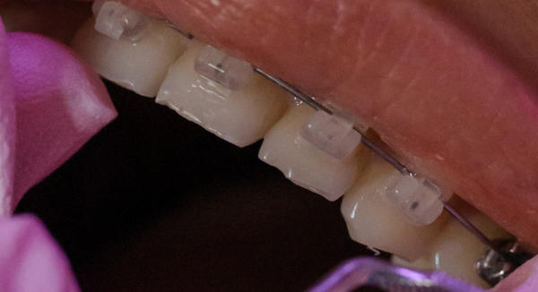 A close up picture of a patient wearing ceramic brackets on the teeth