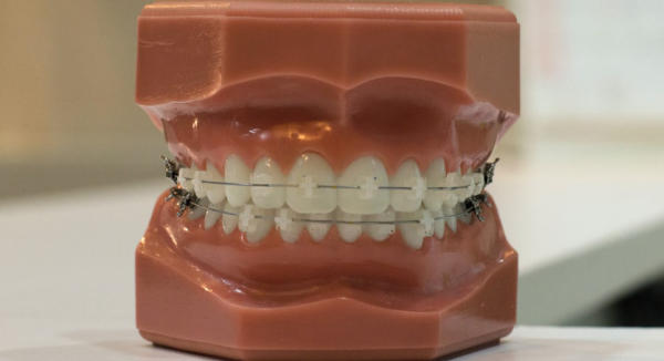 An orthodontic model showing white brackets on the teeth