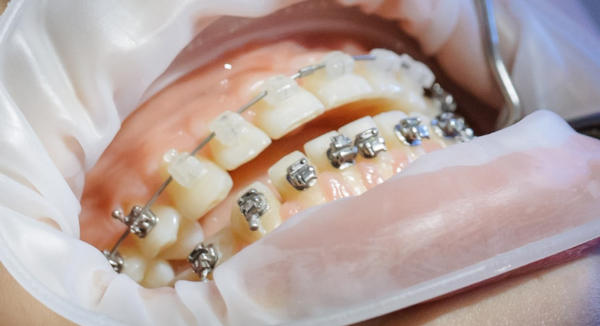 A patient is in the chair with white brackets on the top and metal brackets on the bottom arch of the mouth