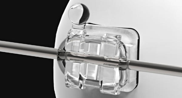 A closeup view of a orthodontic bracket with an archwire and o-ring