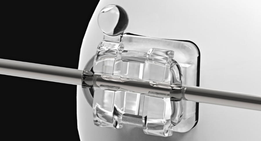 An image of a clear orthodontic bracket with an orthodontic wire in the slot attached by an o-ring