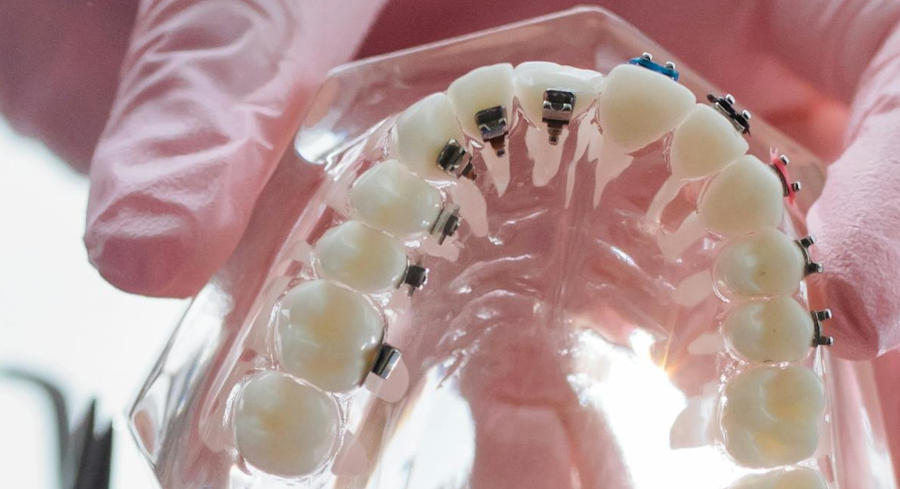 An orthodontist holds up an orthodontic model that has lingual braces applied to the teeth