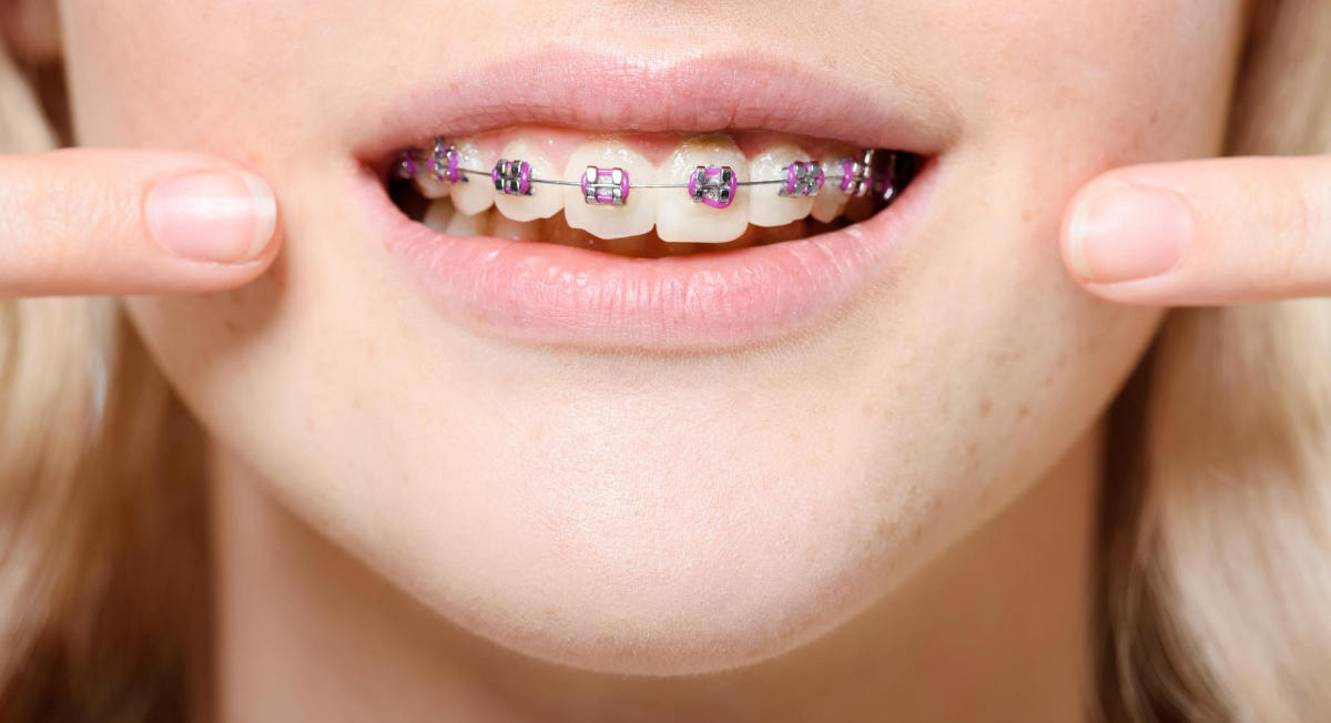 Best Braces Rubber Band Colors Worcester