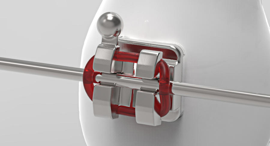 A close up image of an orthodontic bracket, a wire, and an o-ring on a tooth