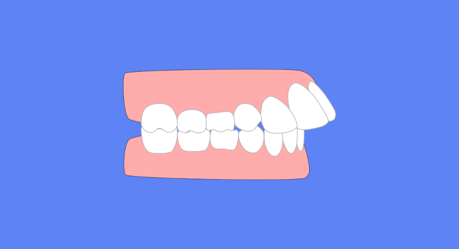 An illustration of a side view of a mouth showing the top teeth jetting forward and outward over the lower teeth