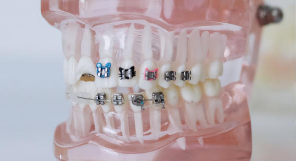 O-rings with different o-ring shapes on a dental model
