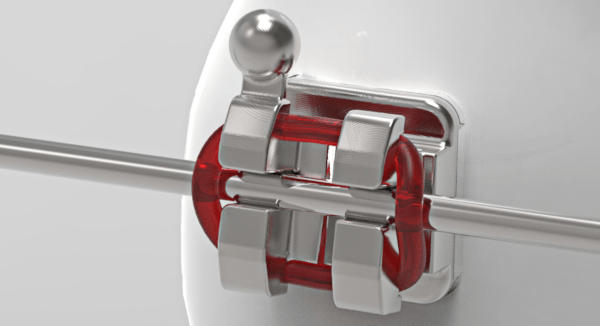 A closeup view of an orthodontic brace / bracket with an archwire and o-ring