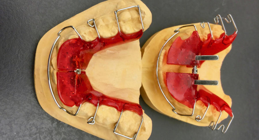 A red orthodontic expander placed on a dental model