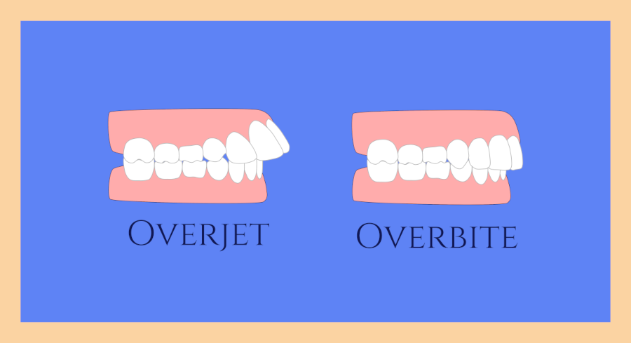 An illustration of a side view of two illustrated mouths, one mouth with an overjet and another mouth with an overbite.