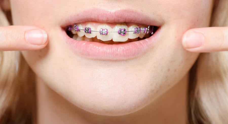 A woman with pink braces pointing to her mouth