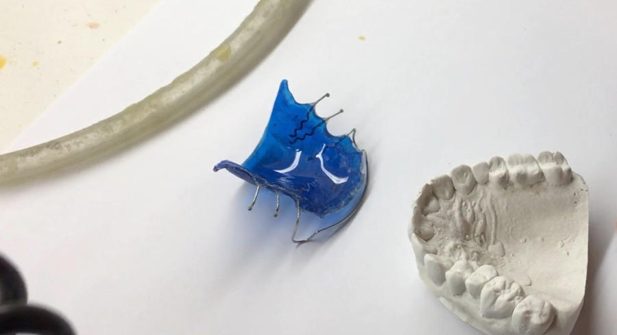 A blue orthodontic retainer being hand polished by Dr. Skarin