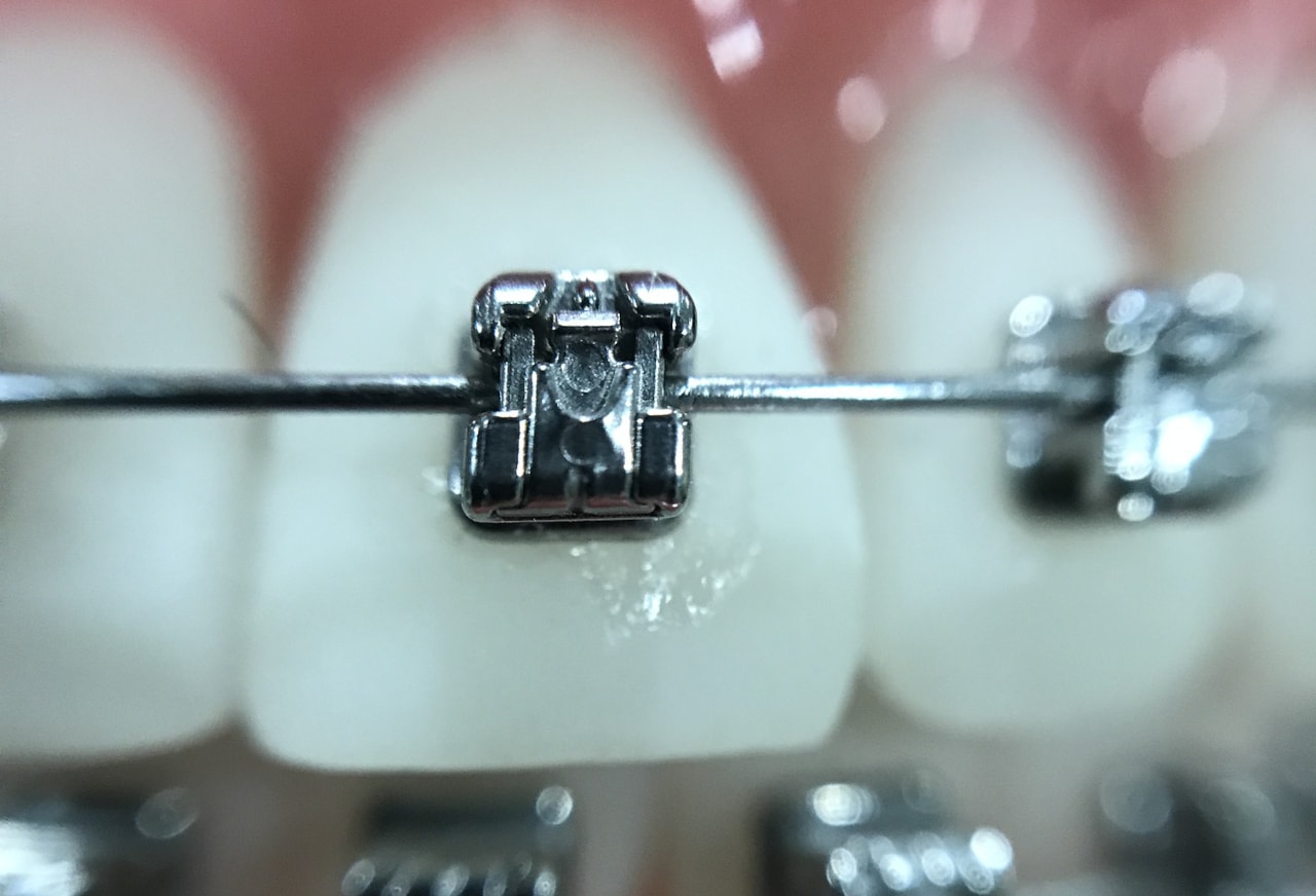 Types of Braces for Straightening Teeth Skarin Orthodontics